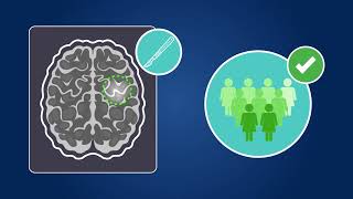 Effects of Molecular Therapeutic and Patient Factors on Outcome of Diffuse LowGrade Glioma [upl. by Patrick]