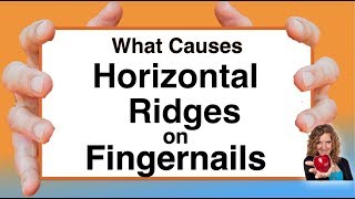 What Causes Horizontal Ridges on Nails With Karen Langston [upl. by Eibrab206]