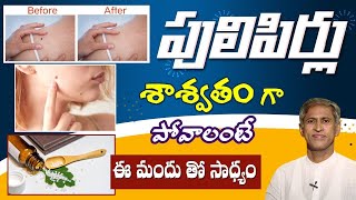 Home Remedy for Warts  Health Tips in Telugu  DrManthenaOfficial [upl. by Bern]