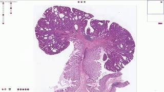 Tubular adenoma  Colon  Histopathology [upl. by Anoo]