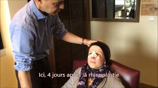 pansement rhinoplastie Tunisie [upl. by Steffen43]