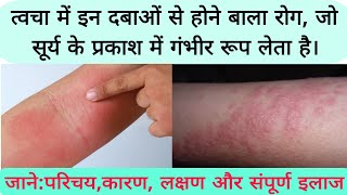 photosensitive eruption eczema disease फोटोसुग्रहित विस्फोट छाजन रोग का कारण लक्षण और संपूर्ण इलाज [upl. by Hoagland876]