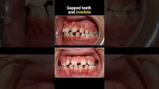 Braces for gapped teeth and overbite braces orthodontist bracesoff dentist [upl. by Brodeur]