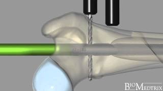 ILoc® IM Fixator Interlocking Nail  BioMedtrix [upl. by Enyawal]