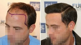 FUE Hair Transplant 3958 grafts in NWClass lVA Dr Juan Couto  FUEXPERT CLINIC  Madrid Spain [upl. by Johny326]