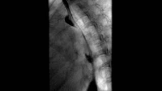 Esophagram Traction Diverticulum [upl. by Rodman]