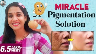 Miracle Pigmentation Solution  DIY Potato Facial Mask  Lakshya Junction [upl. by Layney]