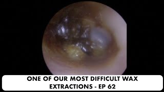 ONE OF OUR MOST DIFFICULT EAR WAX REMOVALS  EP 62 [upl. by Raynata184]