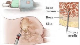 Interpretation of Bone marrow aspiration and Trephine biopsy [upl. by Brinson475]