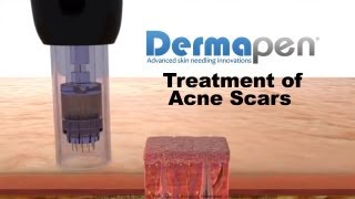 MicroNeedling for Acne Scars  Dermapen® Treatment [upl. by Aik]