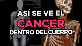 ¿Cómo es que se detecta y se ve el cáncer dentro del cuerpo  PET CT Scanner [upl. by Neve278]