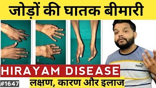 Hirayama Disease Causes Symptoms And Treatment In Hindi [upl. by Echikson]