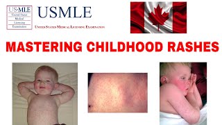 MASTERING CHILDHOOD RASHES MEASLES RUBELLA ROSEOLA SCARLET FEVER USMLE MCC CLINICAL MEDICINE [upl. by Ledarf]