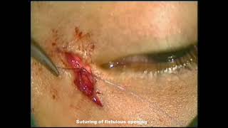 Lacrimal Fistula Repair [upl. by Lesiram]