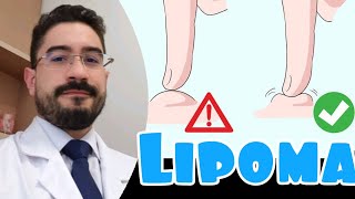 Lipoma  o básico sobre [upl. by Namharludba]