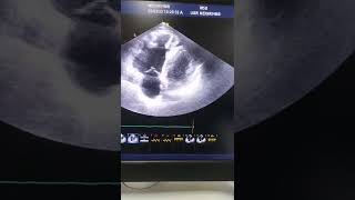 Arrhythmogenic right ventricular Dyspalsia ARVD ECHO [upl. by Hoashis]