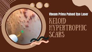 Vbeam Prima Pulsed Dye Laser  Keloid Hypertrophic Scars  West Hollywood CA  Dr Jason Emer [upl. by Htebasil330]