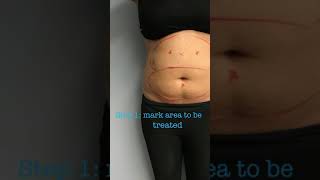 Full CoolSculpting Treatment with Before and Afters [upl. by Cerf608]