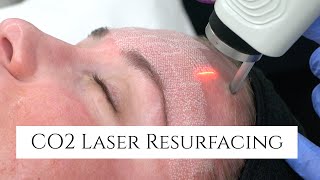 CO2 Laser Facial Rejuvenation  Fix Fine Lines and Wrinkles  Fix Sun Damage  Fix Stretch Marks [upl. by Downing339]