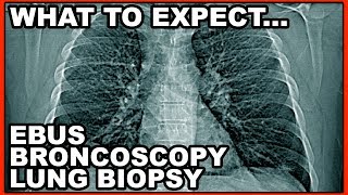 What to expect Bronchoscopy Lung Biopsy EBUS Procedure [upl. by Asoral]