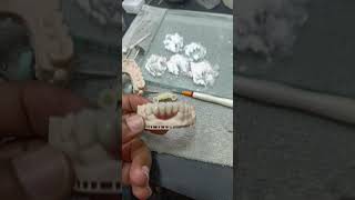 dmls dentist dentex dentalimplants orthodontist dentallaboratory dentalcare pfm zirconia [upl. by Ibob]