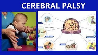 Cerebral Palsy  Symptoms Causes and Treatment [upl. by Dougald685]