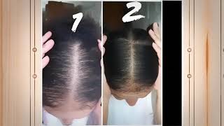 Female Pattern Hair Loss Success Stories [upl. by Tterraj680]