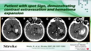 Ischemic and Hemorrhagic Strokes  High Yield [upl. by Ahael41]