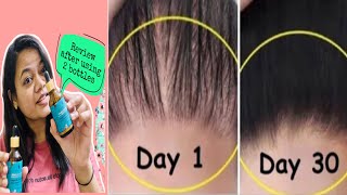 🔴Pilgrim Redensyl amp anagain Hair growth Serum review after using 2 Bottles🧴🧴 [upl. by Ibmat835]