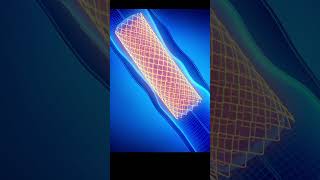 3D Animation of Angioplasty Heart Procedure Medical Animation Explained [upl. by Ingles219]