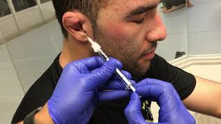 Treating Cauliflower Ear J2LATOS Long Beach [upl. by Ik]