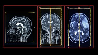 MRI Brain Protocol [upl. by Nnylirej]