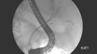 EPIC biliary stent placement [upl. by Schoenburg]