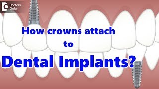 How crowns attach to Dental Implants  Dr Manesh Chandra Sharma [upl. by Emersen]