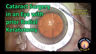 Toric IOL for astigmatism treatment after radial keratotomy [upl. by Thorfinn]