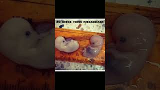 20 weeks twins miscarriage 🤰🥺knowledge easylearning medicalstudents shortsvideo share [upl. by Golliner716]