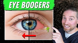 How To Get Rid Of Eye Boogers And Crust 3 Causes and Treatments [upl. by Acsecnarf]