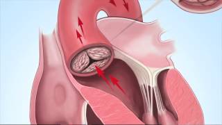 Understanding Aortic Stenosis with Dr Marc Gillinov [upl. by Stubstad]