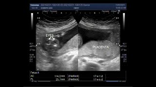 Anencephaly  a neural tube defect [upl. by Arykahs]