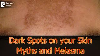 Dark Spots on your Skin  Hormones Vitamin D Melasma  Dr Aruna Prasad [upl. by Terb]