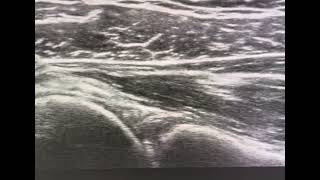 Ultrasound guided glenohumeral joint injection posterior approach with proper flow [upl. by Ronen]