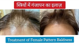 Treatment of Female Pattern Hair Loss  hair loss treatment for women  hair loss kaise roke  FPHL [upl. by Aibun]