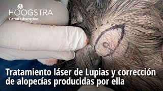 Tratamiento láser de Lupias y corrección de alopecías producidas por ella  24142 [upl. by Wivinah]