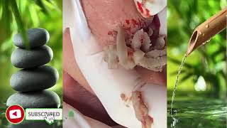 gigantic explotion pimple removal popping boils [upl. by Olivie]