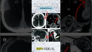 Hidrocefalia Caso Clínico 💀 radiologo casoclínico [upl. by Ahsenauq]