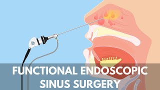 What is a Functional Endoscopic Sinus Surgery [upl. by Anivel874]