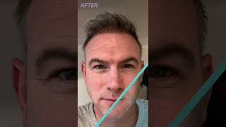 Hair Transplant Turkey Results  Before and After  Longevita [upl. by Nabatse]