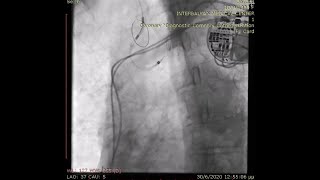 Implanting Sentinel embolic protection device in Bovine Aortic Arch during TAVI [upl. by Means915]