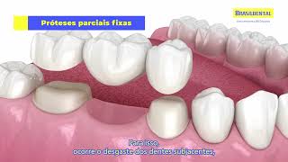 Tipos de Próteses Dentárias  Brasildental [upl. by Jeffrey819]