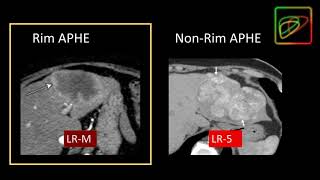 5 LIRADS Malignant lesions that are not definitely HCC LRM  Part 1 By Dr Kathryn Fowler [upl. by Jehius]